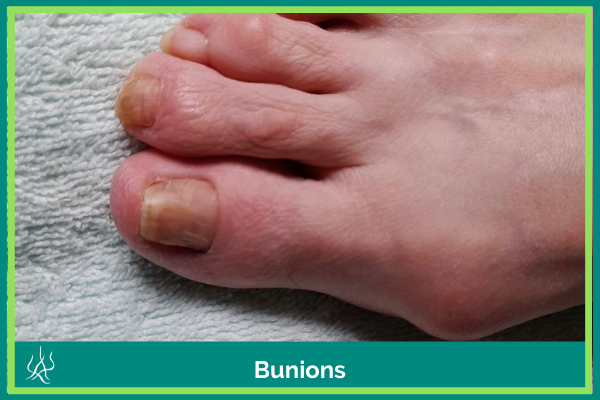 Cockermouth Podiatry Bunions Foot Care Cumbria Allerdale