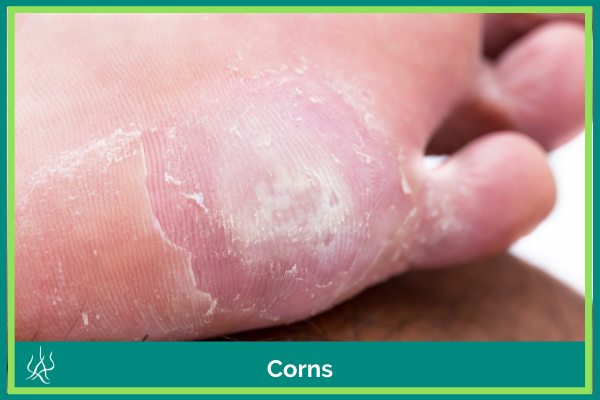 Cockermouth Podiatry Facebook Corns Treatment Chiropody Cumbria