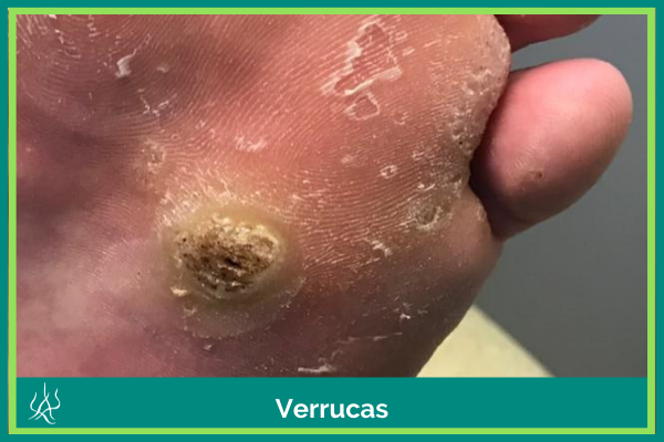 Cockermouth Podiatry Verruca Care Verrucas Cumbria Foot Care